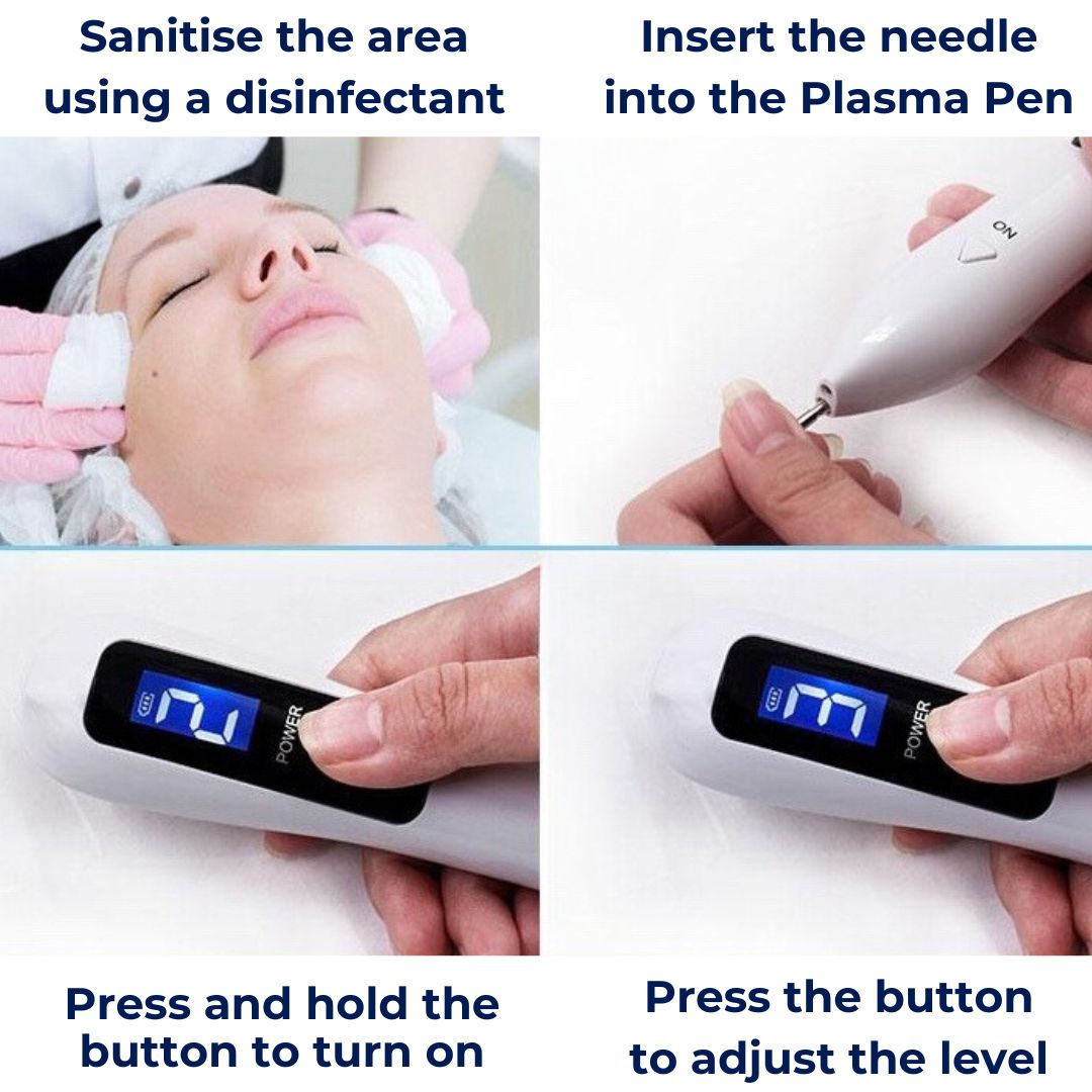 DermaGlow | Mole Removal Pen – Ikke-invasiv plasma – Trådløs & oppladbar – Hjemmebehandling for hudflikker & fregner Luvikno