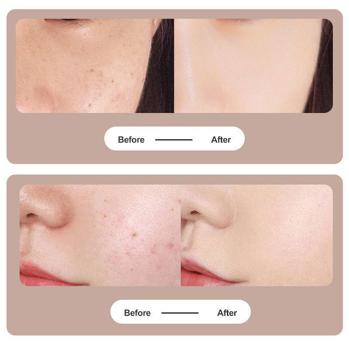 Plasma Pen for tattoo and mole removal | Luvikno