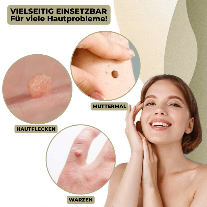 Luvikno | DermaLinx Vortefjerner | Smertfri fjerning av vorter og føflekker | For hjemme | Uten kirurgi
