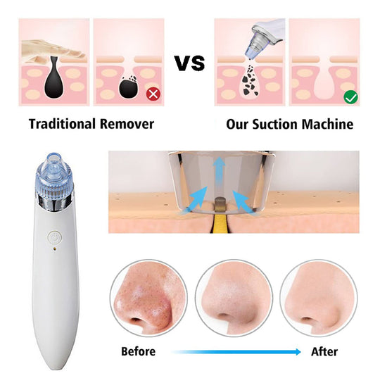 Luvikno | LuxeGlow Elite Blackhead Remover | Oppladbar 4-i-1 løsning for klar, strålende hud
