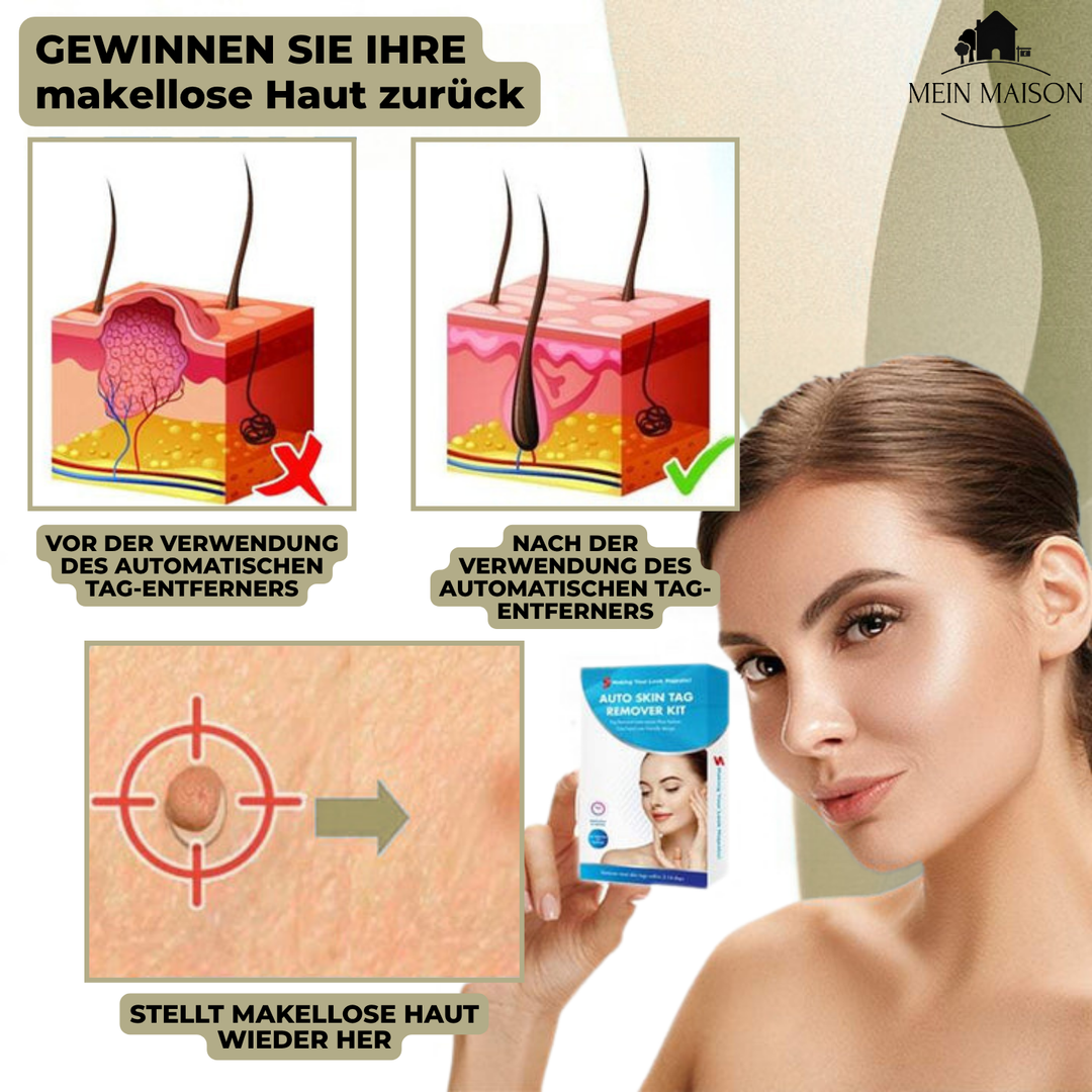 Luvikno | DermaLinx Vortefjerner | Smertfri fjerning av vorter og føflekker | For hjemme | Uten kirurgi