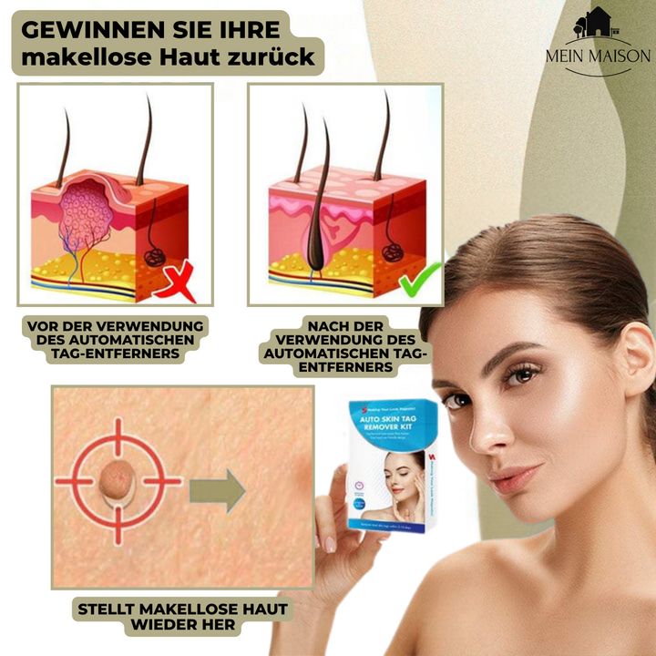 Luvikno | DermaLinx Vortefjerner | Smertfri fjerning av vorter og føflekker | For hjemme | Uten kirurgi