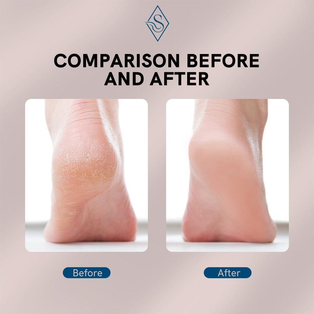 Electric Foot Callus Remover | Luvikno