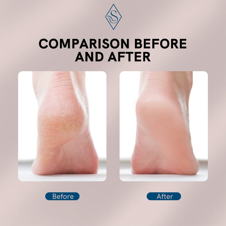 Electric Foot Callus Remover | Luvikno