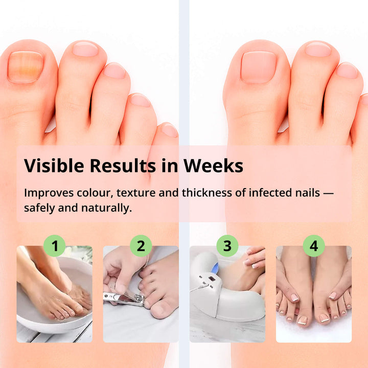 Laser Nail Treatment Device – Rød og blå lys mot neglesopp | Luvikno