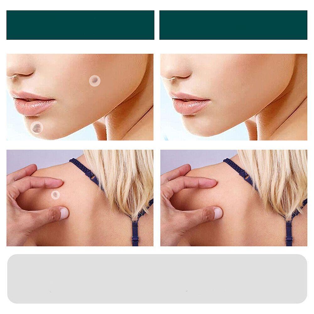 SkinClear - Patches for fjerning av flekker og vorter Luvikno