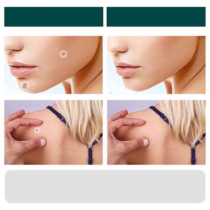 SkinClear - Patches for fjerning av flekker og vorter Luvikno