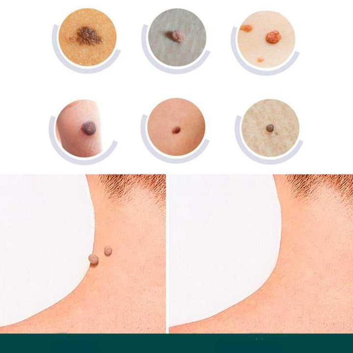 SkinClear - Patches for fjerning av flekker og vorter Luvikno