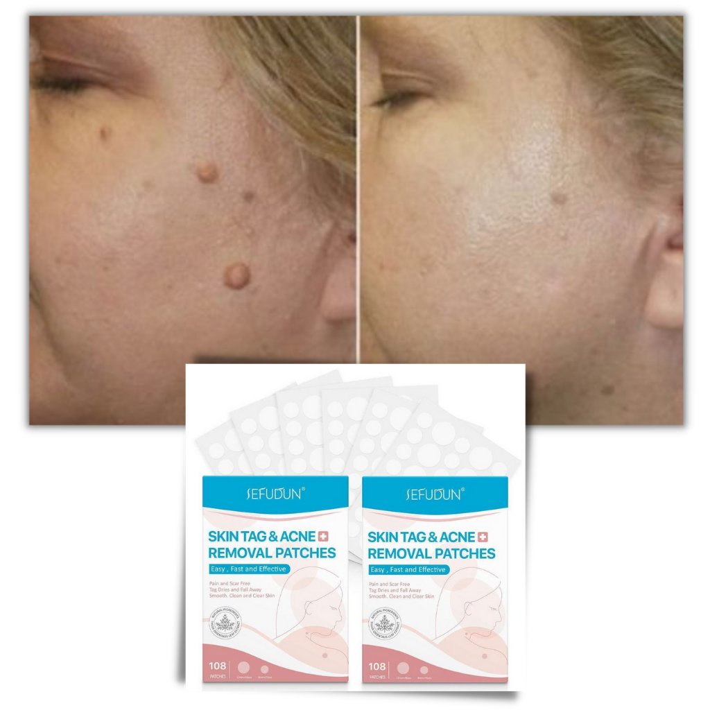 Luvikno | Hudplaster - Fjern føflekker og vorter på en naturlig måte!