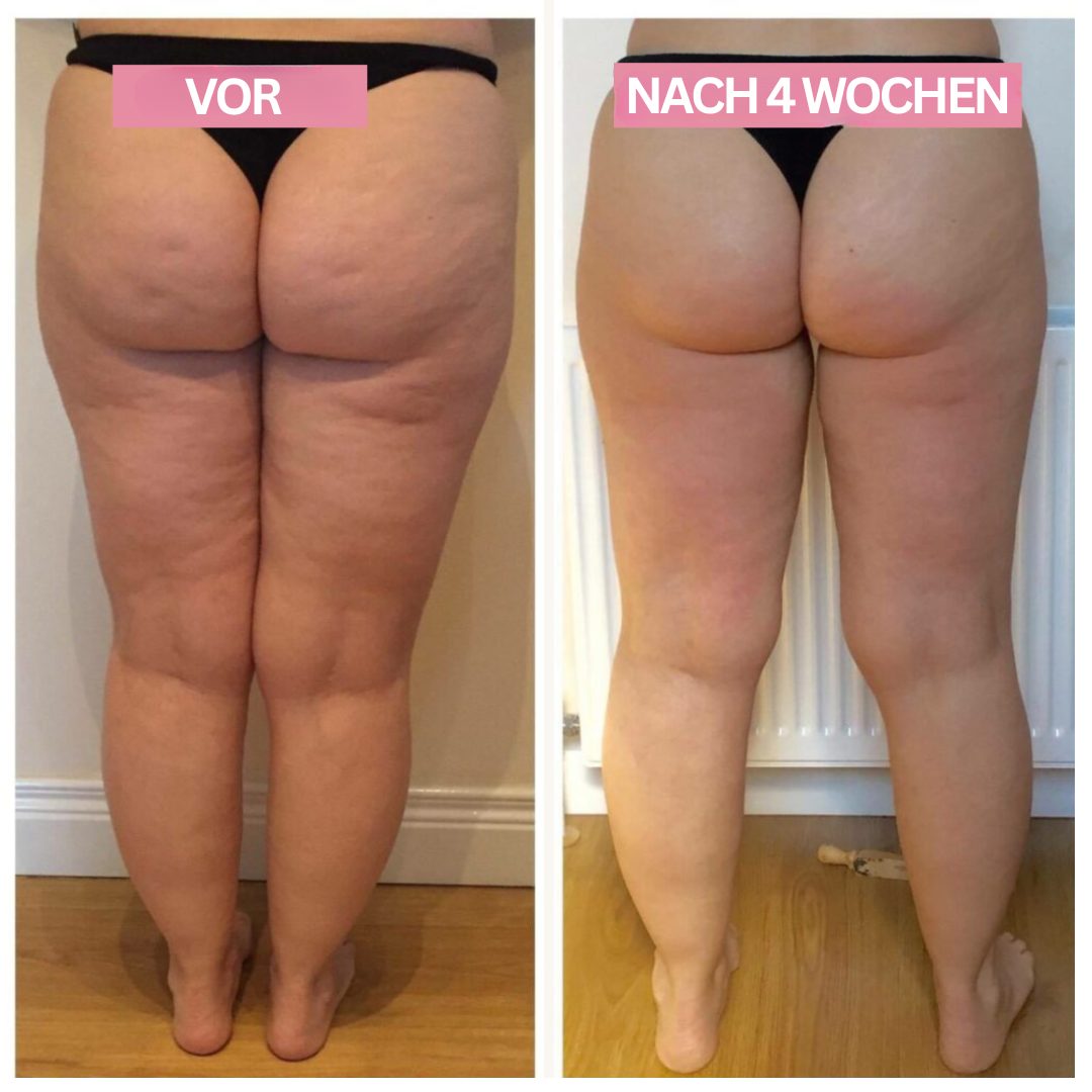 Luvikno | Anti-Cellulitt-Kopping-Enhet – SlimCupp