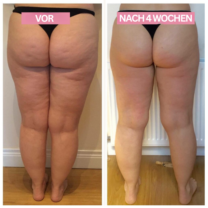 Luvikno | Anti-Cellulitt-Kopping-Enhet – SlimCupp