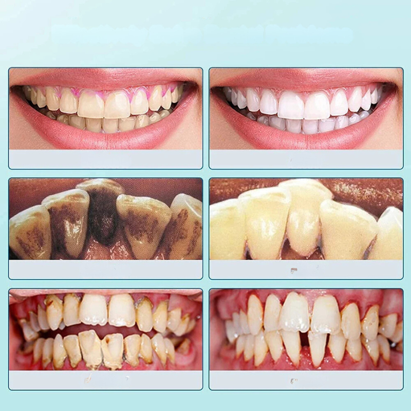 Luvikno | SmilePro Ultrasonic Tannstein Rensesystem – Effektiv Plakkfjerner for Hjemmet
