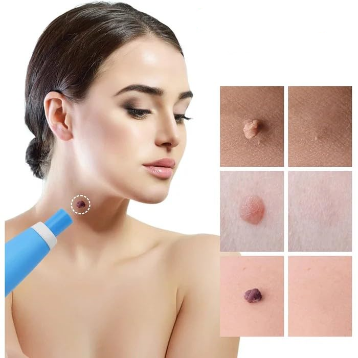 Skin Tag Remover Kit | Ikke-invasiv & Effektiv | Luvikno