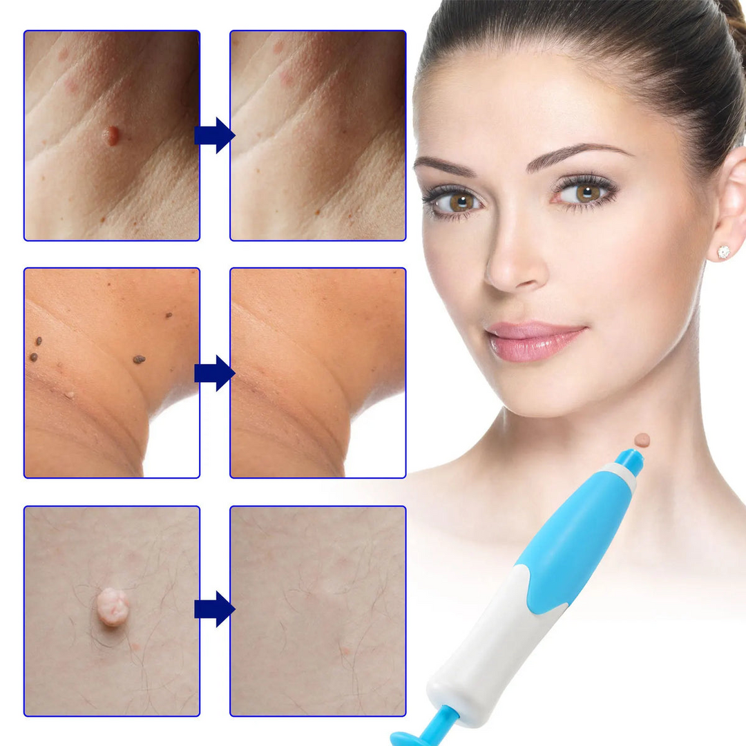 Skin Tag Remover Kit | Ikke-invasiv & Effektiv | Luvikno