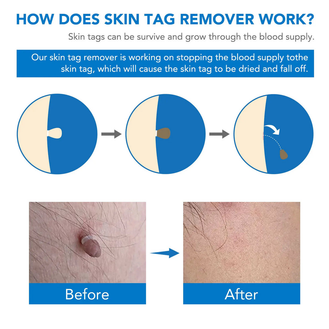 Skin Tag Remover Kit | Ikke-invasiv & Effektiv | Luvikno