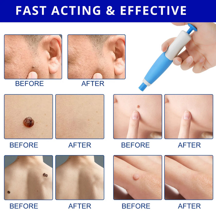 Skin Tag Remover Kit | Ikke-invasiv & Effektiv | Luvikno