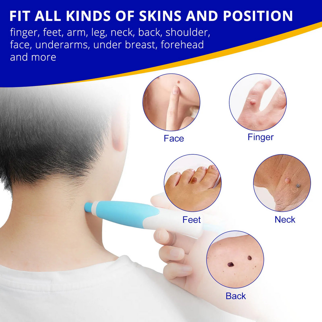 Skin Tag Remover Kit | Ikke-invasiv & Effektiv | Luvikno