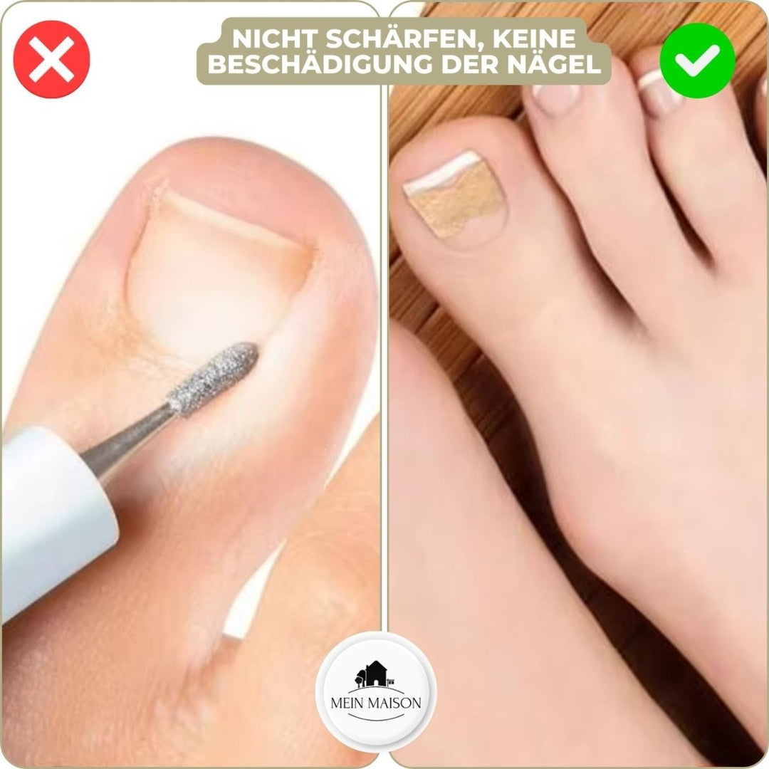Luvikno | ALIGNSTRIP – Smerteløse neglekorrigeringsstrimler for inngrodde og deformerte negler