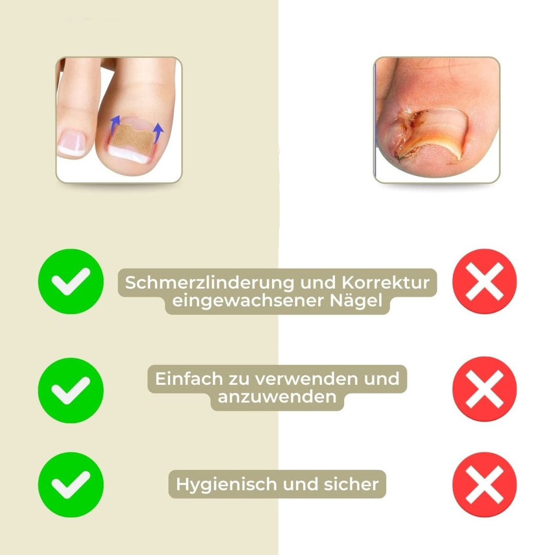 Luvikno | ALIGNSTRIP – Smerteløse neglekorrigeringsstrimler for inngrodde og deformerte negler